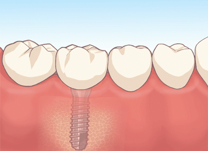 インプラントは一生ものなのか？