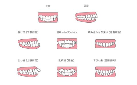 歯並びが悪いのは遺伝が原因？