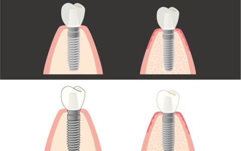 「インプラント」は噛める最高の治療について