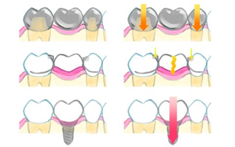 ブリッジとインプラントの違いを知ろう！
