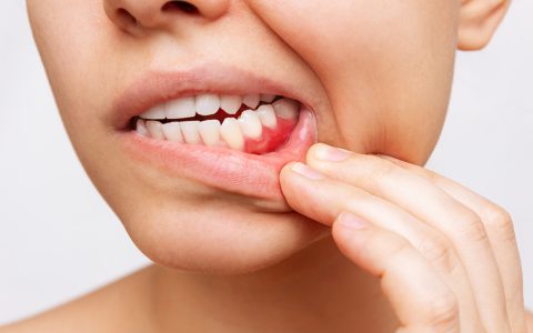 歯周病予防について