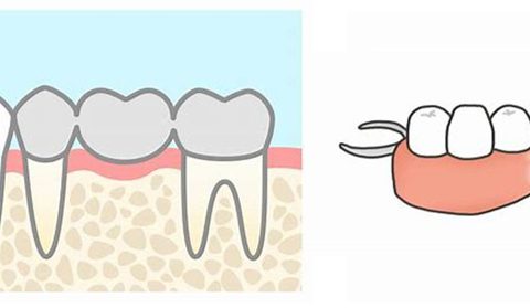 入れ歯とブリッジの違い