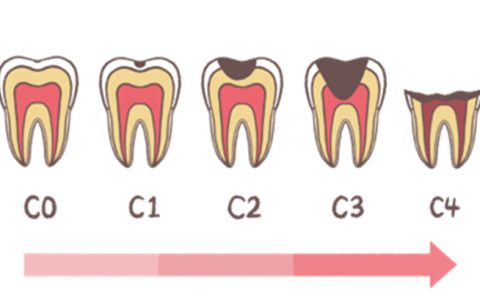 虫歯ってどのくらいで進行するのか