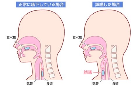 誤嚥性肺炎を予防しよう