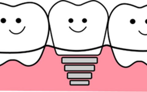 はじめてのインプラント、知っておきたい基礎知識